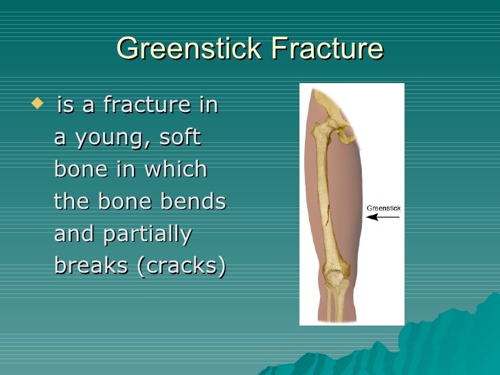 Compound Fracture, Impacted Fracture, Greenstick Fracture