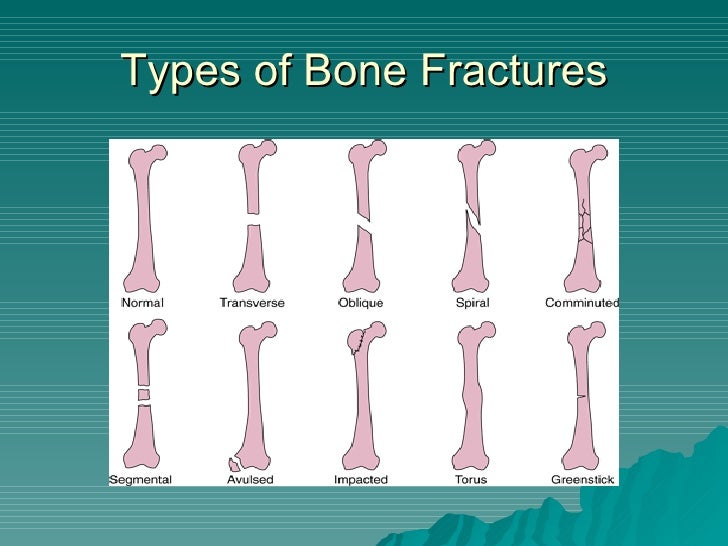 Compound Fracture, Impacted Fracture, Greenstick Fracture