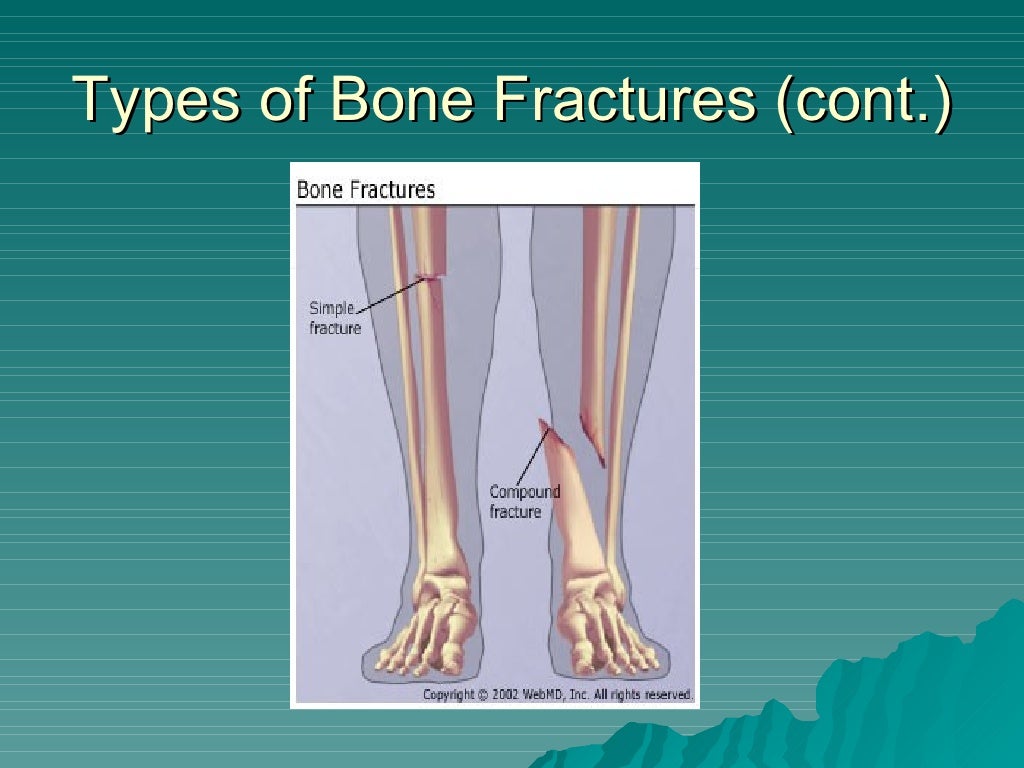 Compound Fracture, Impacted Fracture, Greenstick Fracture