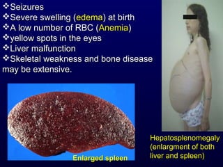 SeizuresSeizures
Severe swelling (Severe swelling (edemaedema) at birth) at birth
A low number of RBC (A low number of RBC (AnemiaAnemia))
yellow spots in the eyesyellow spots in the eyes
Liver malfunctionLiver malfunction
Skeletal weakness and bone diseaseSkeletal weakness and bone disease
may be extensive.may be extensive.
Enlarged spleenEnlarged spleen
HepatosplenomegalyHepatosplenomegaly
(enlargment of both(enlargment of both
liver and spleen)liver and spleen)
 