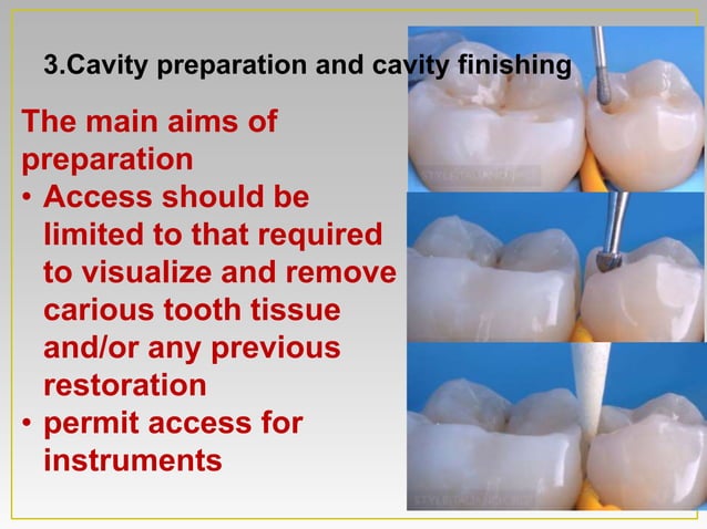 Direct Posterior Composite restoration PPTX Dental Health