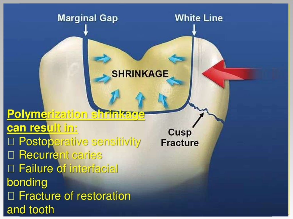 Direct Posterior Composite restoration