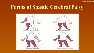 Forms of Spastic Cerebral Palsy
Return to index
 