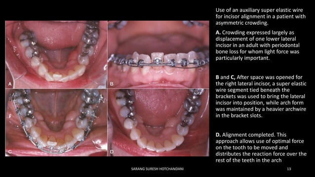 Comprehensive Orthodontic Treatment in the Early Permanent Dentition ...