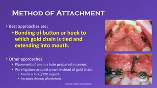 Comprehensive Orthodontic Treatment in the Early Permanent Dentition | PDF