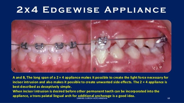 comprehensive orthodontic treatment in the early permanent edgewise appliance