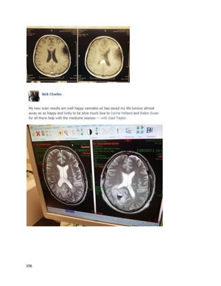 106
A storyfrom October2015 abouta Pennsylvanianman,anonymizedforhislegal protection,described
hissuccessagainstterminal cancerwitha combinationof cannabisand chemotherapy
(http://abc27.com/2015/10/26/cancer-patient-i-had-to-become-an-outlaw-or-die).The manwas
diagnosedwitharare bile ductcancerand givena two-percentchance of survival.Evenwith
chemotherapy,ithadmetastasizedtohisliverandlungs.He beganingestingTHC-richcannabisoil his
wife made forhim;afteralmostthree monthsof the oil and continuingchemotherapy,the cancerinhis
lungswasgone, and the tumorsin hislivershrank,disappeared,orremainedthe same.“Iwasshocked.I
droppedtothe ground.Icouldnot believeit,”saidthe man.“I thoughtitwouldbe a miracle drug for
himand ithas been,”saidhismother.The oncologynurseswere alsosurprisedatthe man’sprogress,
but due to legal reasonshe couldnotinformthemof hissecretmedicine.Furthermore,the mankepthis
hair andgainedweightdespite chemotherapy.
An update fromABC27 publishedFebruary16,2016, revealedthatthe above patientdecidedto
reveal himself inanefforttoinstigate fasterchange (http://abc27.com/2016/02/16/update-cancer-
patient-illegally-healing-with-medical-marijuana-identifies-himself).Randal RayRobertson,56,had been
given9-11 monthsto live afterthe bile ductcancerhad spreadto hisliverandlungs.Interestingly,
Randal actuallyinvitedABC27tohis CATscan, and the doctor allowedthe familytorecordthe results.
The doctor stated,“The CAT scan looksgreat.There are nonodulesinthe lungs.Now,there are justa
couple subcentimeterlesionsonthe liver.The restof the liverlooksgreat.” Randal’slungswerealso still
clearand the remainingsmall tumorsinhisliverhaddecreasedevenmore. “There wasnodenyingat
that pointthat thiswasnot normal and thiswasnot justthe chemotherapy,”Randal said. Hiswife Molly
stated, “We couldhave gone to jail whenwe were actuallyusingit.Imean,we were injeopardy,butwe
had suchamazingresultsthatwe hadto stepout.”
 