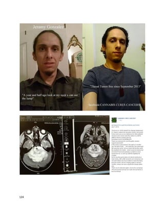 124
A September19, 2014 article describedLindsayCarter's battle withbraincancer
(http://www.sunshinecoastdaily.com.au/news/cannabis-a-lifesaver/2392459). By September2014,
Lindsayhadtraveledtothe UnitedStatesthree timesforcannabisoil treatment.Aftereachvisit,the
tumor reducedsubstantially,includingbyalmosthalf afterone seven-weektreatment.However,upon
returningtoAustraliawhere he couldnotaccesscannabisoil,the tumorbegangrowingagain.A
November5,2014 article describedLindsay’sfourthtriptothe UnitedStates,where he metwithDr.
JeffreyHergenrathertocontinue histreatment
(http://www.couriermail.com.au/news/queensland/lindsay-carter-forced-to-go-to-us-for-cannabis-
treatment-for-brain-tumour/story-fnn8dlfs-1227112641116).
Due to thisneedto travel,Linai andLindsaycouldnotpersonallyappearatthe Australian
Symposium. Inthe above article, Dr.Hergenrathercommented,“We’ve knownforover40 yearsnow
that THC, and the active ingredientsincannabis,are able tokill cancercellsinmanycases… particularly
inthe gliomacell line inthe brain.It’sreallyunethical tokeepthatcannabismedicineawayfrompeople
that really are inneedof it today.We’re creatingthissituationwiththe Carterfamilywhere they’re
refugeeshere inAmericabecause theycan’tuse medical grade cannabisinAustralia.”
An April 26, 2014 article inThe Toronto Sundescribedthe case of Mia Wilkinson,whosuffersfroma
rare epilepticdisordercalledOhtaharasyndrome(http://www.torontosun.com/2014/04/26/medical-
marijuana-gives-epileptic-child-new-lease-on-life).The conditionistypicallyfatal withintwoyearsof
beingborn;infact, Mia experiencedherfirstseizure just29minutesafterbirth.Miaeventuallybegan
suffering100 seizuresaday.Her parentswere eventuallytoldbyMia’sneurologistthatnothingmore
couldbe done,and were almostreadytogive upafterseeingtheirdaughterinanothermedically-
inducedcoma.Asa lastresort,theyaskedtheirdoctorif theycouldtry cannabisoil.Giventhatall
pharmaceuticalshadfailed,he agreed.Withinone dayof tryingcannabisoil,there weredrasticchanges,
includingacessationof Mia’sseizures.AnEEGshowedthe oil had“calmedher ragingbrain.”Doctors
 