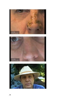 28
homemade oil tobandagesandplacedthemdirectlyonthe skincancersites. Infourdays,the cancers
were gone. Excited,Rickwentbacktohisdoctor’s office toinformthemthathe had curedhimself with
cannabisoil,butthe reactionsfromboththe receptionistanddoctorwere negative.
Afterhisincrediblepersonalexperiences,Rickdecidedhe wantedtohelpothers. He began
growingcannabisinmassive quantitiesinhisbackyard,usingittoproduce thousandsof gramsof oil,
whichhe gave away forfree to anyone inneed. He quicklyobservedthatcannabisoil exertedpanacea-
like effects. Iteliminatedanytype of cancerhe came across and reversednearlyanytype of medical
condition. Diabetes,chronicpain,multiple sclerosis,nervedamage,inflammatoryandautoimmune
disorders,andmental conditionsbecame completelycontrolledordisappeared. Mostpatientscame to
Rick as a lastresort,not believingsomethingassimple ascannabisoil couldreallywork. The standard
treatmentprovidedwas60 gramsto be usedover90 days;thiswas the dosinglevel Rickobservedwas
necessarytoachieve curative effects. However,as massingevidence indicates,sometimesmuchlessor
much more cannabis oil isneededtorealize sucheffects.
Rick’sactivitiesattractedbothmediaandlaw enforcementattention. Inlate 2006, storiesabout
Rick appearedonGlobal National NewsandGlobal Maritimes EveningNews,twopopularCanadian
newsprograms. Priorto that,on August3rd
, 2005, the Royal CanadianMountedPolice raidedRick’s
home,andconfiscated1,190 cannabisplants(http://www.cumberlandnewsnow.com/Justice/2007-09-
13/article-370849/Seized-marijuana-plants-had-value-up-to-830000-RCMP/1).Althoughthe citedarticle
states1,190, Rick saidthe plantcount wasactually1,620; one of the newsreportsalsomentionsacount
numberaround1,600. The raidledto a trial in September2007, where Rickfacedchargesincluding
possessionof lessthan30 grams of cannabis,possessionof lessthanthree kilogramsof
tetrahydrocannabinol forthe purpose of trafficking,andunlawful productionof cannabis. He wasfound
guiltyonall charges. Whendiscussinganadjournmentforsentencing,Ricksaidthe followingtoJudge
Felix Cacchione:
“It may be betterto lockme up rightnow.As soonas I get home I’mgoingto treatmy patients.
I’mgoingto grow that plantuntil the dayI die,soI mightas well be putin jail today.Ican’t stopin the
middle of [treatment].People’slivesare atstake here.”
(http://www.cumberlandnewsnow.com/Justice/2007-09-19/article-381209/Simpson-guilty/1).
Simpsonwasscheduledtoreturntocourt forsentencingon November30, 2007. However,
while awaitingsentencing,SimpsonwasarrestedagainfortraffickingTHC,andwas remandedforfour
daysuntil beingreleased. WhenSimpsonwassentencedforhisfirstcharges,he receiveda$2,000 fine,
prohibitiononownershipof firearms(asisthe case withmostdrug charges),andone day custody,
deemedservedbyhiscourtappearance. Judge Cacchione explainedhisdecision,saying,“Mr.Simpson
has a sincere belief he hasa cure withthisoil and shouldbe commended,butin reality,he broke the
law”(http://www.cumberlandnewsnow.com/Justice/2008-02-11/article-382416/Simpson-considers-
leaving-country/1).Inearly2008, Rickreturnedtocourt to face the charge relatedtohis secondarrest,
and wassentencedtoeightdaysincustodyby Judge Carole Beaton. Aswiththe firstcase,the custody
time wasdeemedservedbyRick’spreviousremandtime.
“Mr. Simpsonisinan unusual position,because unlike otherpeople engagedinthe drugtrade,
he was not engagedintraffickingforfinancial gain,"saidJudge CaroleBeaton."He wasengagedinan
altruisticactivityandwasfirminhisbelief thathe washelpingothers”(http://www.salem-
news.com/articles/december052009/rick_simpson_bk.php).
 