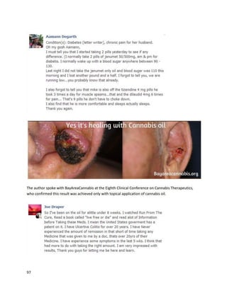 97
By October2013, testsshoweda“markedimprovement”inlungsandchestspace,althoughshe
still hadthe metastasesinherhipand spine.SusannahthenstoppedchemotherapyinDecember,
placingherfull faithinthe cannabisoil.The article concludesherstory:
“Her mostrecentCT scan report,datedJuly7 [2014], saysher lungsare stable with‘residual scarringat
the site of previouslungmetastases’.‘Thesehave notprogressedandare stable inappearance,’the
reportsays.
‘Scleroticlesions’inherspine, sternumandribsare stable,‘reasonablyextensivebonymetastasesinthe
pelvisare stable inappearance’andno‘definite bonymetastases’inherfemorawere detecteddespite
a dedicatedCTscan. Ms Patchsaidshe was continuingtotake a much smallerdailydose of cannabisoil
and waslookingforwardtoher nextcheck-up.”
Asbestos.com, one of the leadingresourcesforindividualsandfamilies affectedbymesothelioma,
publishedaNovember14,2014 story abouta man namedAndyAshcraftwhose life wassignificantly
changedwithcannabisextracttreatment (http://www.asbestos.com/news/2014/11/14/cannabis-oil-
cancer-treatment).Mesotheliomaisone of the mostaggressive cancers,with60% of patientsdying
withinayear of diagnosis.
AndywasdiagnosedwithmesotheliomainFebruary2010, whichhadalreadymetastasized
outside hislungs. Atthe apparentendof battle,anexperimental chemotherapeuticdrughadstopped
workinganddoctors toldhiswife Ruthitwastime for palliativecare ora hospice facility.Andy had
already survivedpastexpectations,andaround thistime hadthree gallonsof fluiddrainedfromhis
lungsand abdomen atonce.Despite the doctor’sprognosis,Ruthrefusedtogive upandacquired
cannabisoil throughCalifornia’slegal program.
 