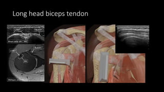 Long head biceps tendon
 