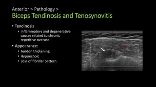 Anterior > Pathology >
Biceps Tendinosis and Tenosynovitis
• Tendinosis
• Inflammatory and degenerative
causes related to chronic
repetitive overuse
• Appearance:
• Tendon thickening
• Hypoechoic
• Loss of fibrillar pattern
 