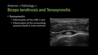 Anterior > Pathology >
Biceps tendinosis and Tenosynovitis
• Tenosynovitis
• Inflammation of the LHBT is rare
• Inflammation of the surrounding
synovial sheath is more common
 