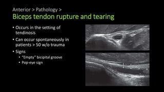 Anterior > Pathology >
Biceps tendon rupture and tearing
• Occurs in the setting of
tendinosis
• Can occur spontaneously in
patients > 50 w/o trauma
• Signs
• “Empty” bicipital groove
• Pop-eye sign
 