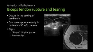 Anterior > Pathology >
Biceps tendon rupture and tearing
• Occurs in the setting of
tendinosis
• Can occur spontaneously in
patients > 50 w/o trauma
• Signs
• “Empty” bicipital groove
• Pop-eye sign
 