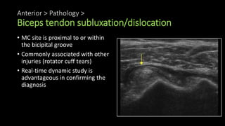 Anterior > Pathology >
Biceps tendon subluxation/dislocation
• MC site is proximal to or within
the bicipital groove
• Commonly associated with other
injuries (rotator cuff tears)
• Real-time dynamic study is
advantageous in confirming the
diagnosis
 