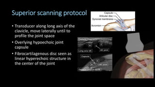 Superior scanning protocol
• Transducer along long axis of the
clavicle, move laterally until to
profile the joint space
• Overlying hypoechoic joint
capsule
• Fibrocartilagenous disc seen as
linear hyperechoic structure in
the center of the joint
 
