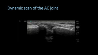 Dynamic scan of the AC joint
 