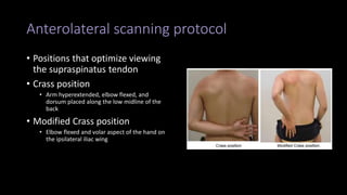 Anterolateral scanning protocol
• Positions that optimize viewing
the supraspinatus tendon
• Crass position
• Arm hyperextended, elbow flexed, and
dorsum placed along the low midline of the
back
• Modified Crass position
• Elbow flexed and volar aspect of the hand on
the ipsilateral iliac wing
 