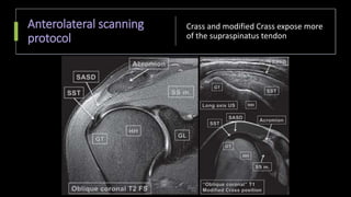 Anterolateral scanning
protocol
Crass and modified Crass expose more
of the supraspinatus tendon
 