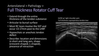 Anterolateral > Pathology >
Full Thickness Rotator Cuff Tear
• Extend through the entire
thickness of the tendon substance
• Articular to bursal surface
• Most RC tears involve the SST and
occur 13-17mm post to the LHBT
• Hypoechoic or anechoic tendon
defect
• Describe: location and dimensions
in short and long axis, shape
(crescent-shaped, L-shaped),
presence of retraction
63/M w/ right shoulder pain
Full thickness supraspinatus tendon tear
 