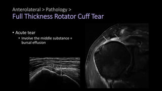 Anterolateral > Pathology >
Full Thickness Rotator Cuff Tear
• Acute tear
• Involve the middle substance +
bursal effusion
 