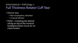 Anterolateral > Pathology >
Full Thickness Rotator Cuff Tear
• Chronic tear
• Non-visualization, retraction
• (-) bursal effusion
• Pitfall – mistaking the deltoid
sitting on top of the humeral
head/granulation tissue for an
intact tendon
 