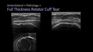 Anterolateral > Pathology >
Full Thickness Rotator Cuff Tear
 