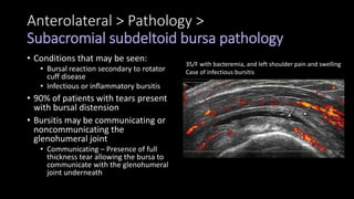 Anterolateral > Pathology >
Subacromial subdeltoid bursa pathology
• Conditions that may be seen:
• Bursal reaction secondary to rotator
cuff disease
• Infectious or inflammatory bursitis
• 90% of patients with tears present
with bursal distension
• Bursitis may be communicating or
noncommunicating the
glenohumeral joint
• Communicating – Presence of full
thickness tear allowing the bursa to
communicate with the glenohumeral
joint underneath
35/F with bacteremia, and left shoulder pain and swelling
Case of infectious bursitis
 