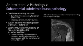 Anterolateral > Pathology >
Subacromial subdeltoid bursa pathology
• Conditions that may be seen:
• Bursal reaction secondary to rotator
cuff disease
• Infectious or inflammatory bursitis
• 90% of patients with tears present
with bursal distension
• Bursitis may be communicating or
noncommunicating the
glenohumeral joint
• Communicating – Presence of full
thickness tear allowing the bursa to
communicate with the glenohumeral
joint underneath
35/F with bacteremia, and left shoulder pain and swelling
Case of infectious bursitis
 