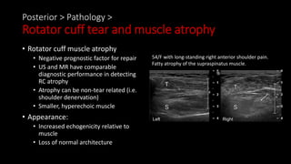 Posterior > Pathology >
Rotator cuff tear and muscle atrophy
• Rotator cuff muscle atrophy
• Negative prognostic factor for repair
• US and MR have comparable
diagnostic performance in detecting
RC atrophy
• Atrophy can be non-tear related (i.e.
shoulder denervation)
• Smaller, hyperechoic muscle
• Appearance:
• Increased echogenicity relative to
muscle
• Loss of normal architecture
54/F with long-standing right anterior shoulder pain.
Fatty atrophy of the supraspinatus muscle.
 