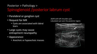 Posterior > Pathology >
Spinoglenoid /posterior labrum cyst
• Paralabral or ganglion cyst
• Request for MR
• Cysts are associated with labral
tears
• Large cysts may cause
entrapment neuropathy
• Appearance:
• Anechoic or hypoechoic masses
28/M with left shoulder pain.
Lobulated cyst seen the posterior region.
 