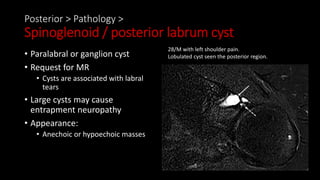 Posterior > Pathology >
Spinoglenoid / posterior labrum cyst
• Paralabral or ganglion cyst
• Request for MR
• Cysts are associated with labral
tears
• Large cysts may cause
entrapment neuropathy
• Appearance:
• Anechoic or hypoechoic masses
28/M with left shoulder pain.
Lobulated cyst seen the posterior region.
 
