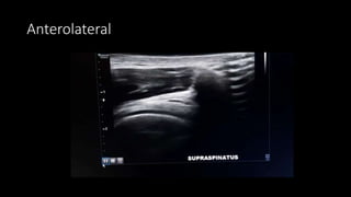 Anterolateral
 