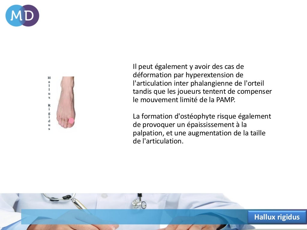 Comprendre les douleurs du gros orteil telles que le Hallux rigidus