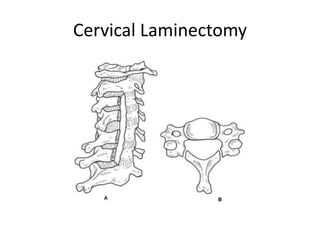 Cervical Laminectomy
 