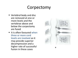Corpectomy
 Vertebral body and disc
are removed at one or
more levels and the
vertebrae above and
below the corpectomy
are fused
 It is often favoured when
three or more cord
levels are involved as it
may provide superior
decompression and a
higher rate of successful
fusion in these cases
 