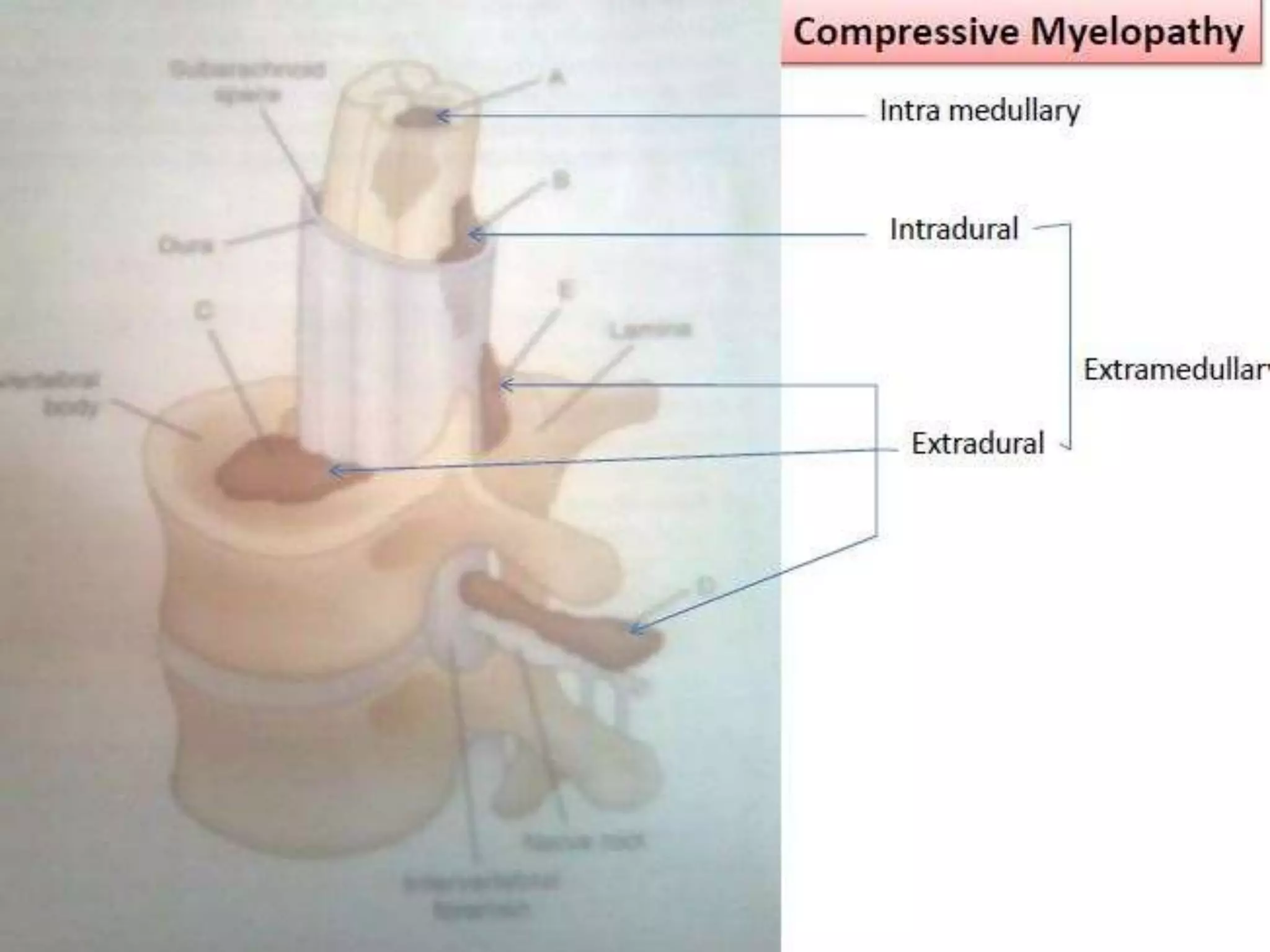 Compressive myelopathy - Etiology, Pathogenesis, Clinical Features ...