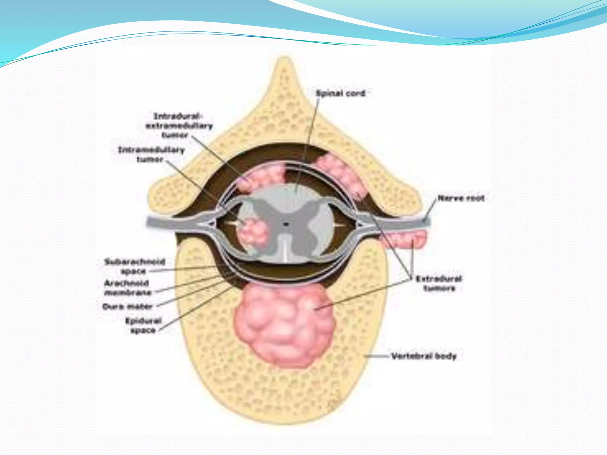 Compressive myelopathy - Etiology, Pathogenesis, Clinical Features ...
