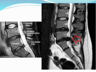 Compressive myelopathy - Etiology, Pathogenesis, Clinical Features ...