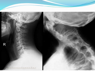 Compressive myelopathy - Etiology, Pathogenesis, Clinical Features ...
