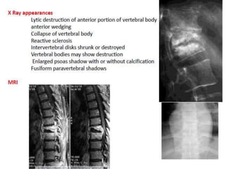 Compressive myelopathy - Etiology, Pathogenesis, Clinical Features ...