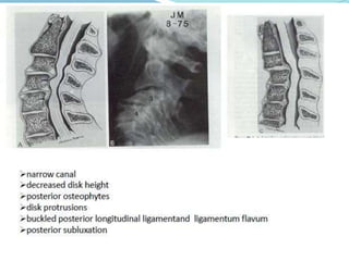 Compressive myelopathy - Etiology, Pathogenesis, Clinical Features ...