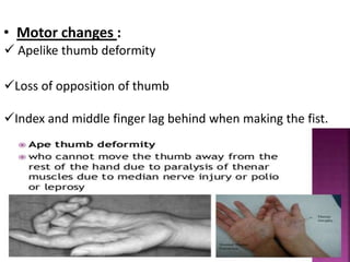 • Motor changes :
 Apelike thumb deformity
Loss of opposition of thumb
Index and middle finger lag behind when making the fist.
 