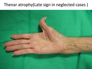 Thenar atrophy(Late sign in neglected cases )
 