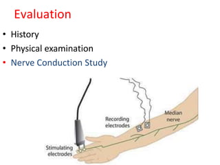 Evaluation
• History
• Physical examination
• Nerve Conduction Study
 