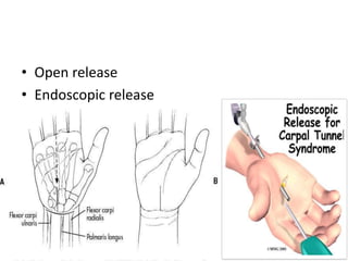 • Open release
• Endoscopic release
 