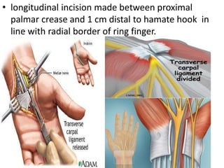 • longitudinal incision made between proximal
palmar crease and 1 cm distal to hamate hook in
line with radial border of ring finger.
 