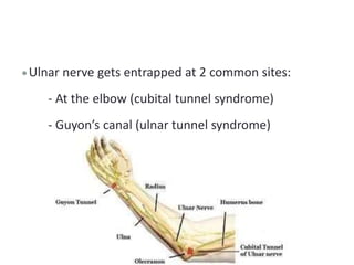 Ulnar nerve gets entrapped at 2 common sites:
- At the elbow (cubital tunnel syndrome)
- Guyon’s canal (ulnar tunnel syndrome)
 