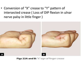 • Conversion of “X” crease to “Y” pattern of
intersected crease ( Loss of DIP flexion in ulnar
nerve palsy in little finger )
 